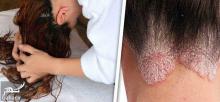 عوارض خطرناک خوابیدن با موهای نم دار
