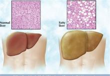 علت ایجاد «کبد چرب» از نظر طب سنتی 