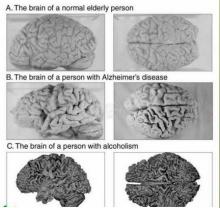 الکل و آلزایمر چه تاثیری روی مغز انسان دارد؟+تصاویر 